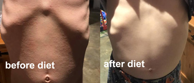 1454eczema