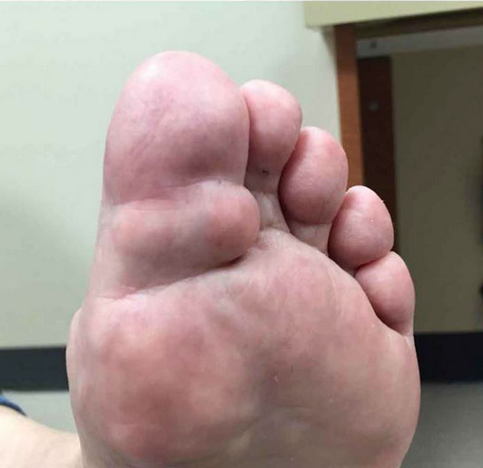 gout02
