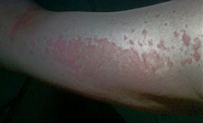 rash001